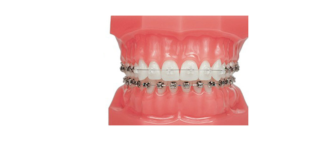 Ceramic Braces, Damon Braces in London